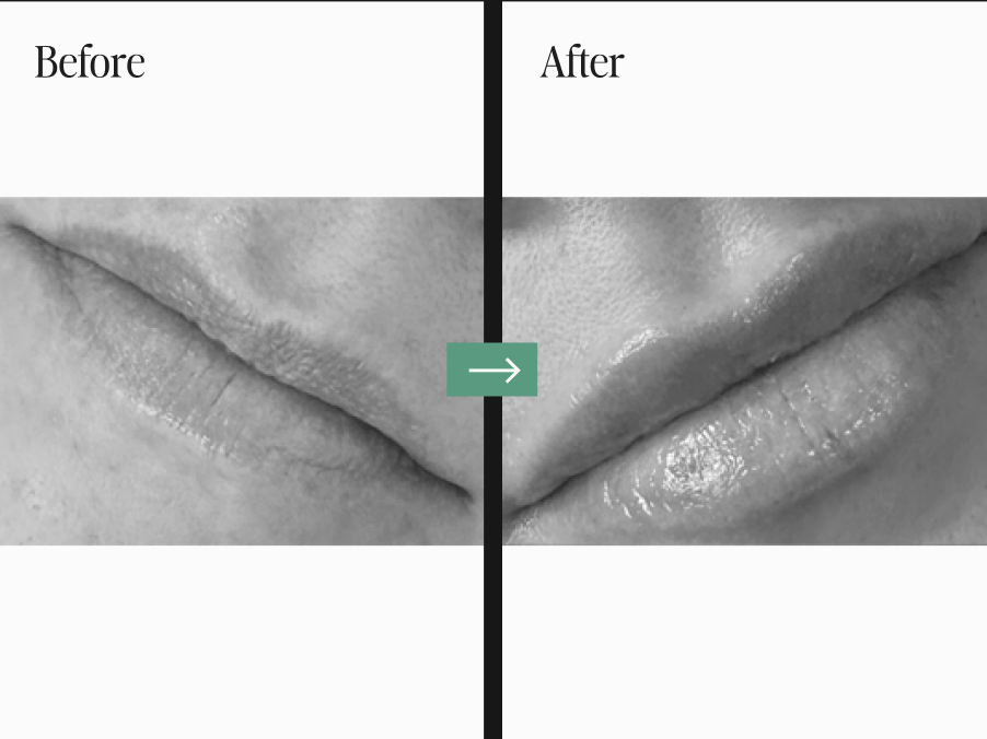 Dermal Fillers and Injectables Before and After Pictures Charleston County, SC